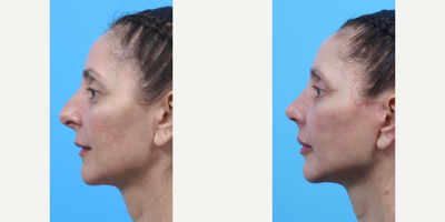 Case: 7153 - before and after photo of Woman treated with Eyelid Surgery, Neck Lift, Lip Lift, Lip Implants, Facelift, Rhinoplasty by Caitlin Iorio, MD