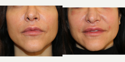 Case: 7154 - before and after photo of 35-44 year old woman treated with Lip Implants by Ryan Mitchell, DO, FAOCO