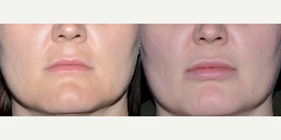 Case: 7155 - before and after photo of 32 year old woman treated with Lip Implants. by Landon Pryor, MD, FACS