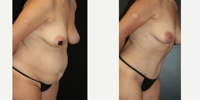 Case: 7156 - before and after photo of 35-44 year old woman treated with Tummy Tuck, Liposuction, Lip Implants by Otto Joseph Placik, MD