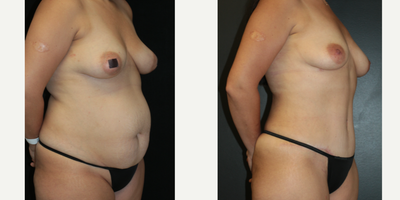 Case: 7157 - before and after photo of 35-44 year old woman treated with Tummy Tuck, Liposuction, Lip Implants by Otto Joseph Placik, MD