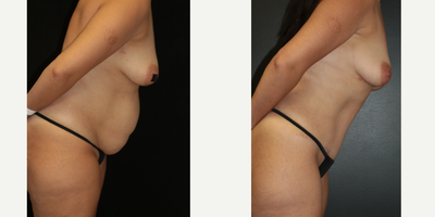 Case 7158 - 35-44 year old woman treated with Tummy Tuck, Liposuction, Lip Implants