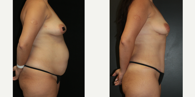 Case 7159 - 35-44 year old woman treated with Tummy Tuck, Liposuction, Lip Implants