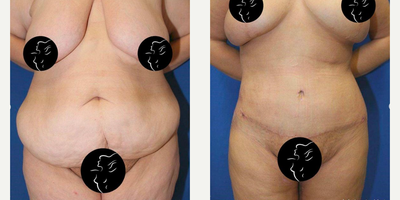 Case 716 - 25-34 year old woman treated with Tummy Tuck