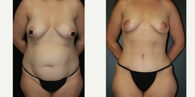 Case 7160 - 35-44 year old woman treated with Tummy Tuck, Liposuction, Lip Implants