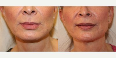 Case 7161 - 55-64 year old woman treated with Lip Implants