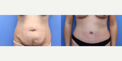 Case 717 - Woman treated with Tummy Tuck