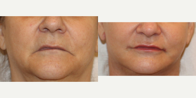 Case 7176 - 65-74 year old woman treated with Lip Implants