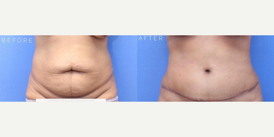 Case 718 - Woman treated with Tummy Tuck