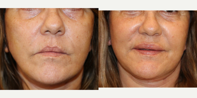 Case 7180 - 45-54 year old woman treated with Lip Implants