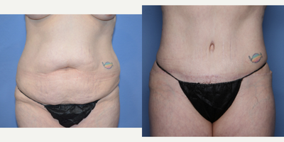 Case 719 - 35-44 year old woman treated with Tummy Tuck