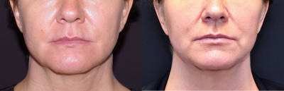 Case 7195 - 45-54 year old woman treated with Lip Implants