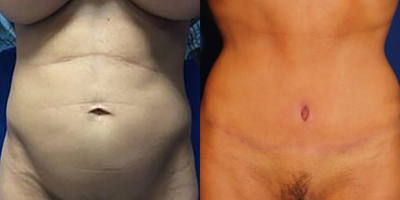 Case 72 - Woman treated with Tummy Tuck