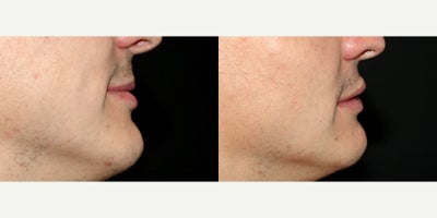 Case 7224 - 34 year old man treated with Lip Implants
