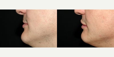 Case 7225 - 34 year old man treated with Lip Implants