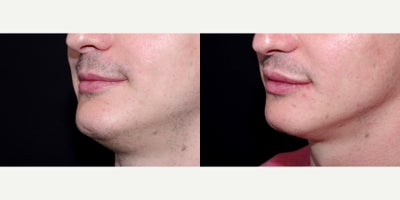 Case 7226 - 34 year old man treated with Lip Implants