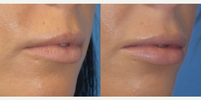 Case 7230 - 25-34 year old woman treated with Lip Implants