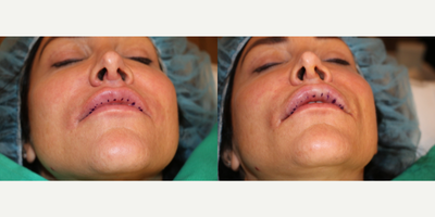 Case 7231 - 45-54 year old woman treated with Lip Implants