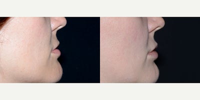 Case 7233 - 32 year old woman treated with Lip Implants