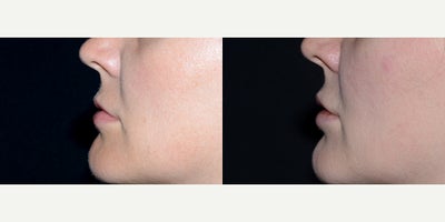 Case 7234 - 32 year old woman treated with Lip Implants