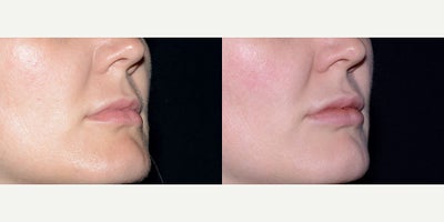 Case 7235 - 32 year old woman treated with Lip Implants