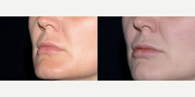 Case 7236 - 32 year old woman treated with Lip Implants