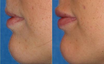 Case 7240 - Woman treated with Lip Implants