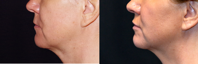 Case 7264 - 45-54 year old woman treated with Lip Implants