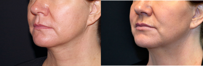 Case 7265 - 45-54 year old woman treated with Lip Implants