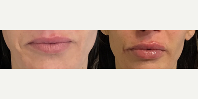 Case: 7283 - before and after photo of Woman treated with Restylane Kysse, Juvederm, Lip Fillers by Vivek Bansal, MD