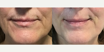Case: 7284 - before and after photo of Woman treated with Restylane Kysse, Juvederm, Lip Fillers by Vivek Bansal, MD