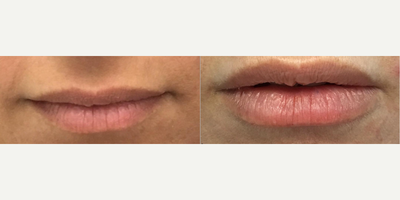 Case: 7285 - before and after photo of Woman treated with Lip Fillers by Urmen Desai, MD, MPH, FACS