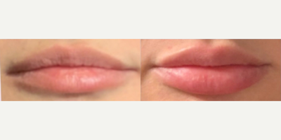 Case: 7286 - before and after photo of Woman treated with Lip Fillers by Vivek Bansal, MD