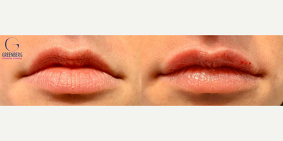 Case: 7287 - before and after photo of Woman treated with Lip Fillers, Restylane by Stephen T. Greenberg, MD, FACS