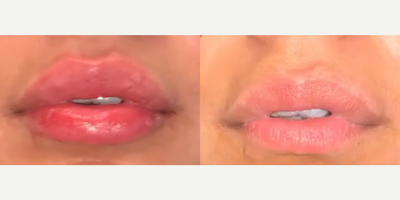 Case: 7288 - before and after photo of Woman treated with Lip Fillers, Restylane by Stephen T. Greenberg, MD, FACS