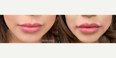 Case: 7289 - before and after photo of Woman treated with Lip Fillers by Vivek Bansal, MD