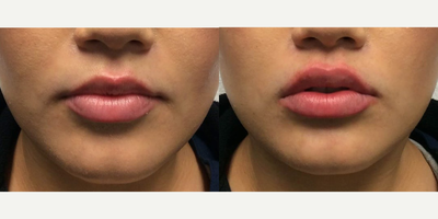 Case: 7290 - before and after photo of Woman treated with Juvederm, Lip Fillers by Naveen Setty, MD