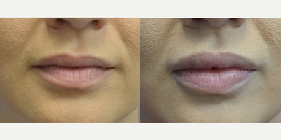 Case: 7291 - before and after photo of Woman treated with Juvederm, Lip Fillers by Naveen Setty, MD