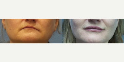 Case 7292 - Woman treated with Juvederm, Lip Fillers