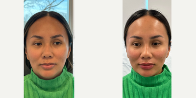 Case 7293 - 35-44 year old woman treated with Dermal Fillers, Cheek Augmentation, Lip Fillers