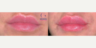 Case 7294 - Woman treated with Lip FIllers