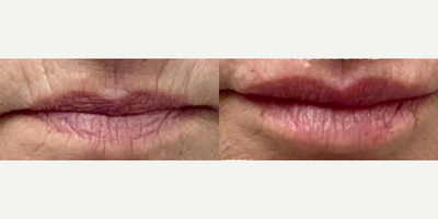 Case 7296 - Woman treated with Lip Lift, Volbella, Dermal Fillers, Lip Fillers