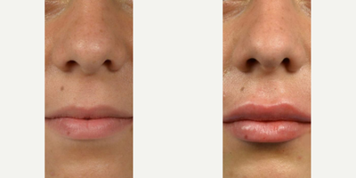 Case 7297 - Juvederm, Lip Fillers, Lip Lift, Dermal Fillers
