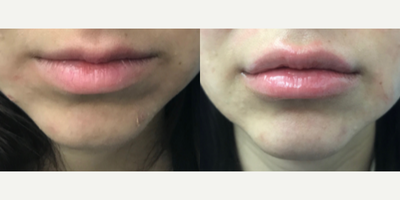 Case 7298 - Woman treated with Lip Fillers