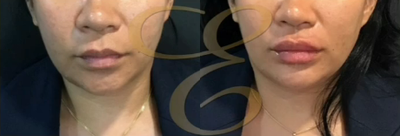 Case 7300 - Woman treated with Lip Fillers