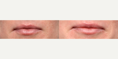 Case 7301 - 35-44 year old woman treated with Restylane Refyne, Lip Fillers