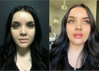 Case 7302 - Woman treated with Lip Fillers