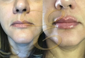 Case 7304 - Woman treated with Lip Fillers