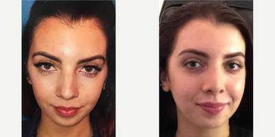 Case 7305 - Woman treated with Lip Fillers