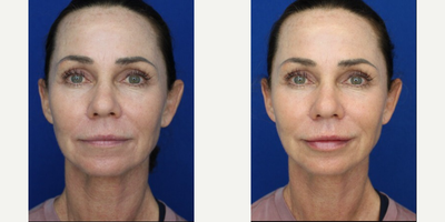 Case 7306 - Woman treated with Lip Fillers